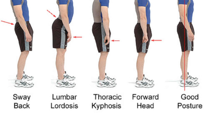 Gejala Penyakit Lordosis, Cari Tahu untuk Bisa Memberikan Pengobatan