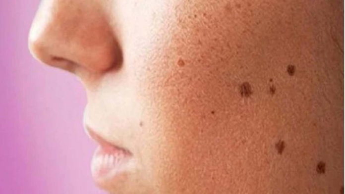 Skin Care Untuk Flek Hitam Dengan Mencegah Produksi Melanin