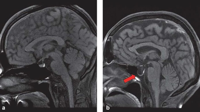 Empty Sella Syndrome, Gangguan Kesehatan yang Jarang Terjadi