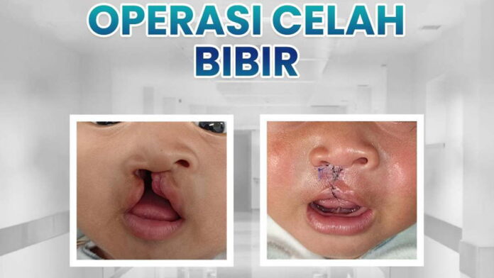 Dokter RSUD Pandega Pangandaran Jelaskan Prosedur Operasi Bibir Sumbing